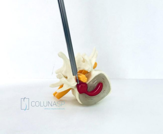 endoscopia-cirurgia-coluna-hernia-de-disco