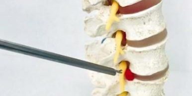 Endoscopia da Coluna