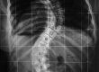 Escoliose