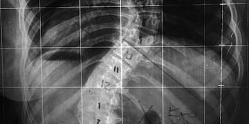 Escoliose