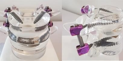 Cirurgias de Artrodese-Fixação Percutânea Cirurgias de Artrodese-Fixação Percutânea