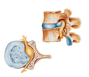 Hernia discal lombo-sacra - SBRATE