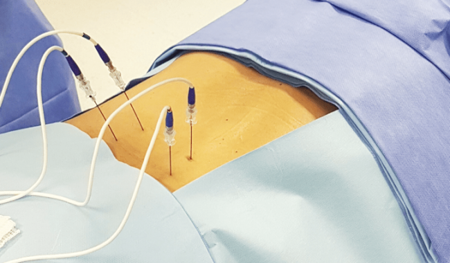 Rizotomia Facetária por Radiofrequência