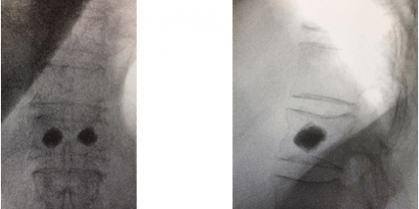 Cifoplastia (para tratamento de Fraturas)