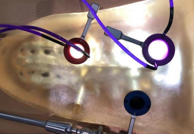 Microdiscectomia Tubular