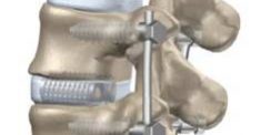Cirurgia de Espondilolistese: Artrodese