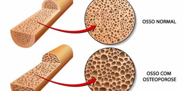 Cirurgia de Fratura na Coluna: Osteoporose