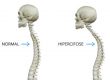 Tratamento pra cifose: hipercifose