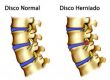 Tratamento para Hérnia de Disco: Diagnóstico