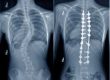 Cirurgia de Escoliose: Exame
