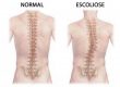 Tratamento para Escoliose: Diagnóstico