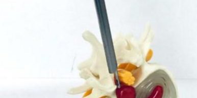 Cirurgia Endoscópica da Coluna: Procedimento