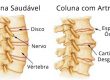 Artrose na Coluna
