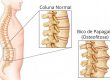 Bico de Papagaio na coluna vertebral (osteofitose)