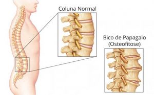 Bico de Papagaio ou Osteofitose - Coluna SP