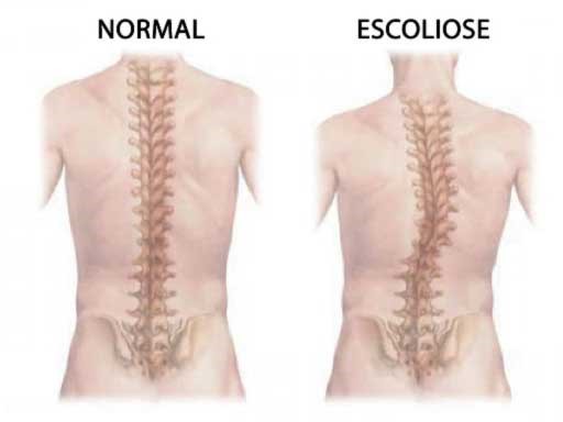 Homem com deficiência de postura defeito escoliose e rolamento